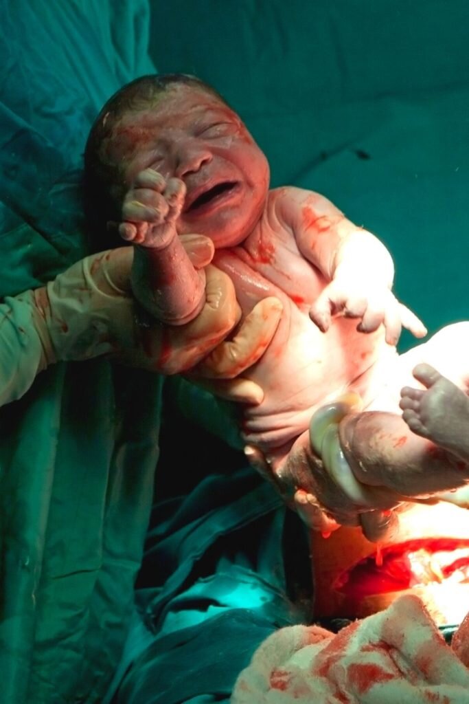 parto cesárea humanizada 3